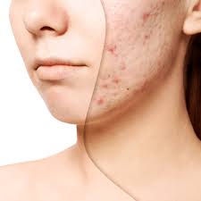 Clarifying Acne Facial
