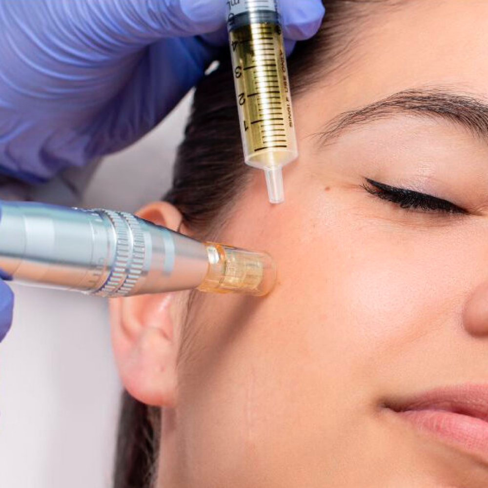 MICRONEEDELING PARA ACNE at STONE AESTHETICS in West columbia, SC