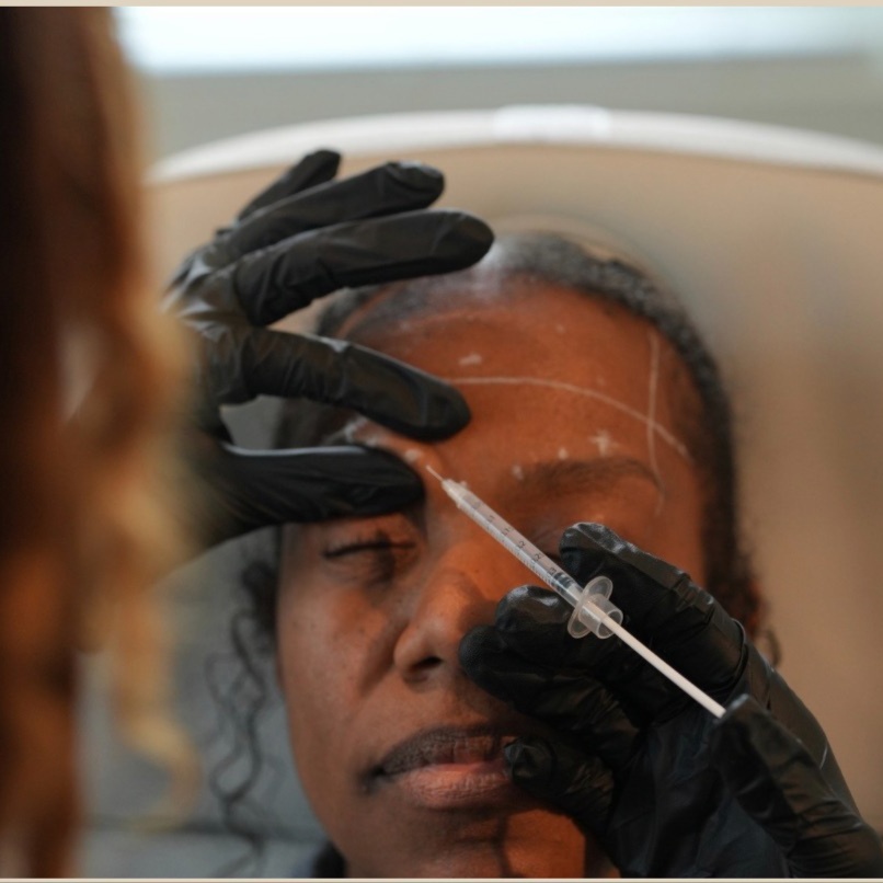 Jeuveau (wrinkle reducer) at Theia Medical Spa in Vinings, GA