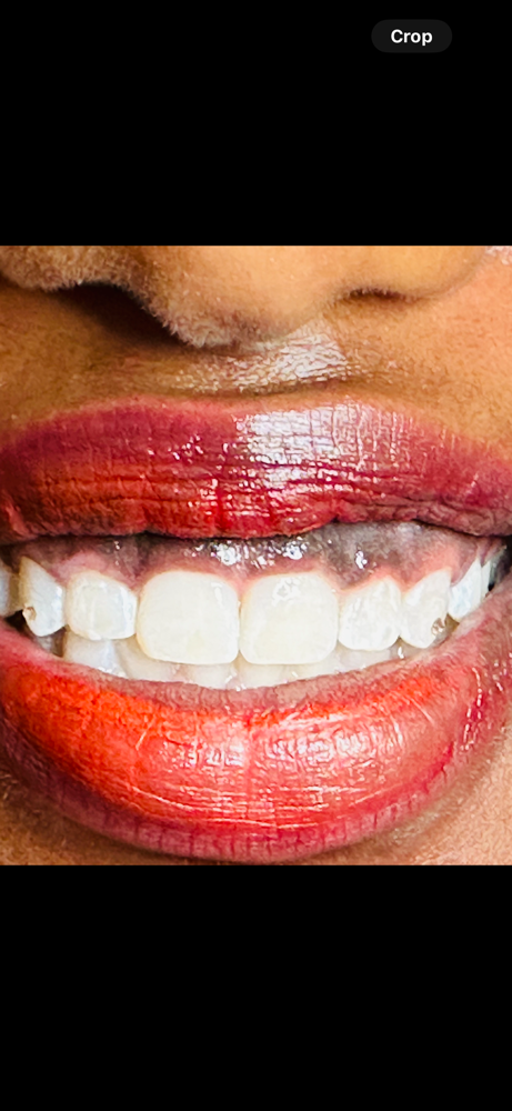 Full Whitening Session Add On Gems