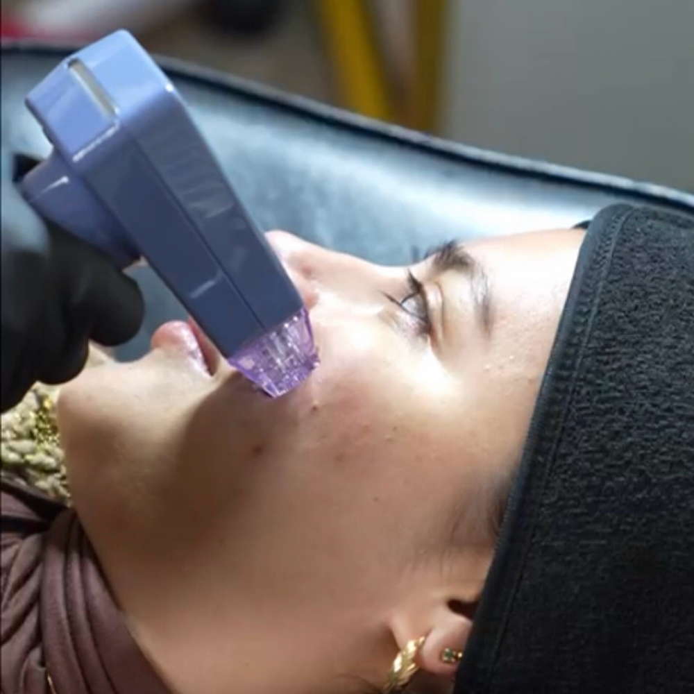 Morpheus8 - 1 Session at Kelly Sorza Beauty Esthetic in San Jose, CA