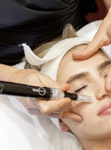 Microneedling