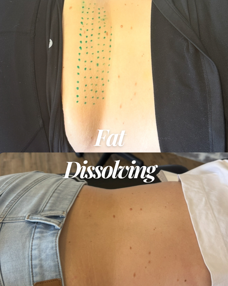 Fat Dissolving