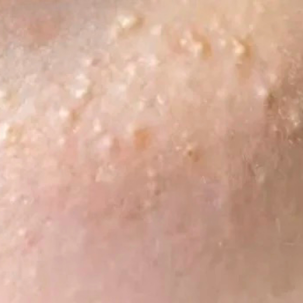 Milia Extraction at Bliss Beauty Spa in Thomaston, ME