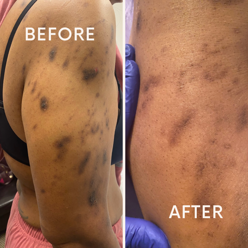 Chemical Peel at Eximius Bella in Garner, NC