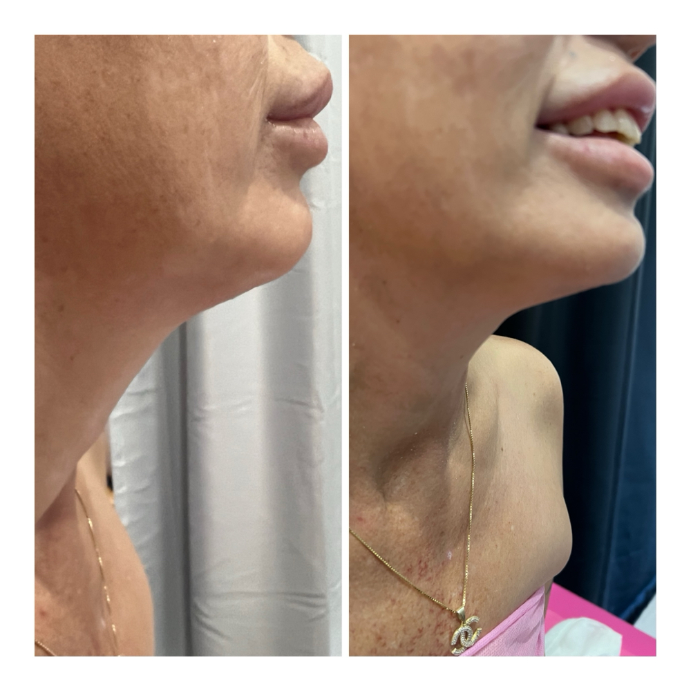 Chin Lipo