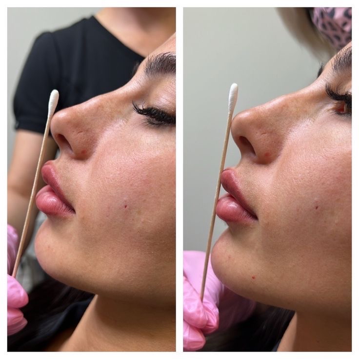 Chin + Lips Filler