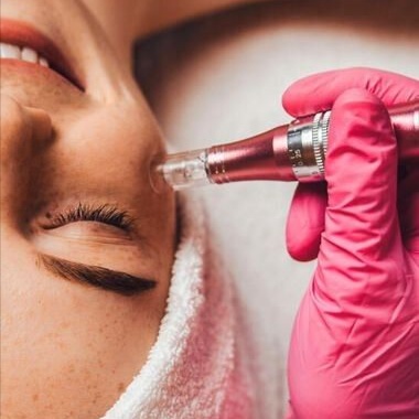 Skin Renewal Microneedling at AGELESS SKIN BY ASEEL MED SPA in Prosper, TX