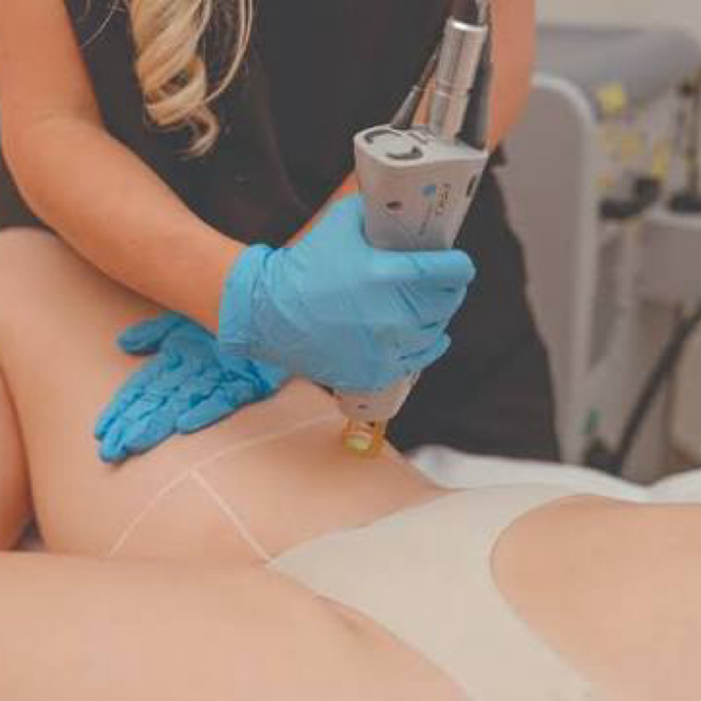 Laser Hair Removal- Brazilian at Chatuge Med Spa & Fitness in Hiawassee, GA