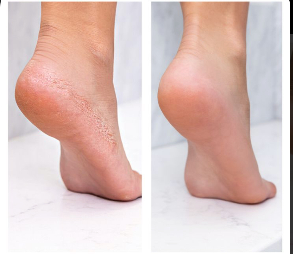 Basic Pedicure W/Callus Treatment