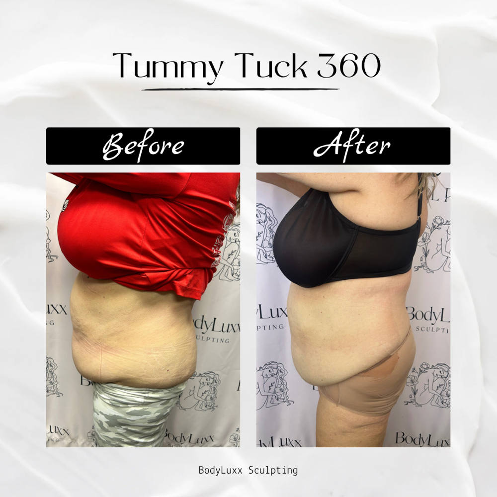 Tummy Tuck 360 (3 Sessions)