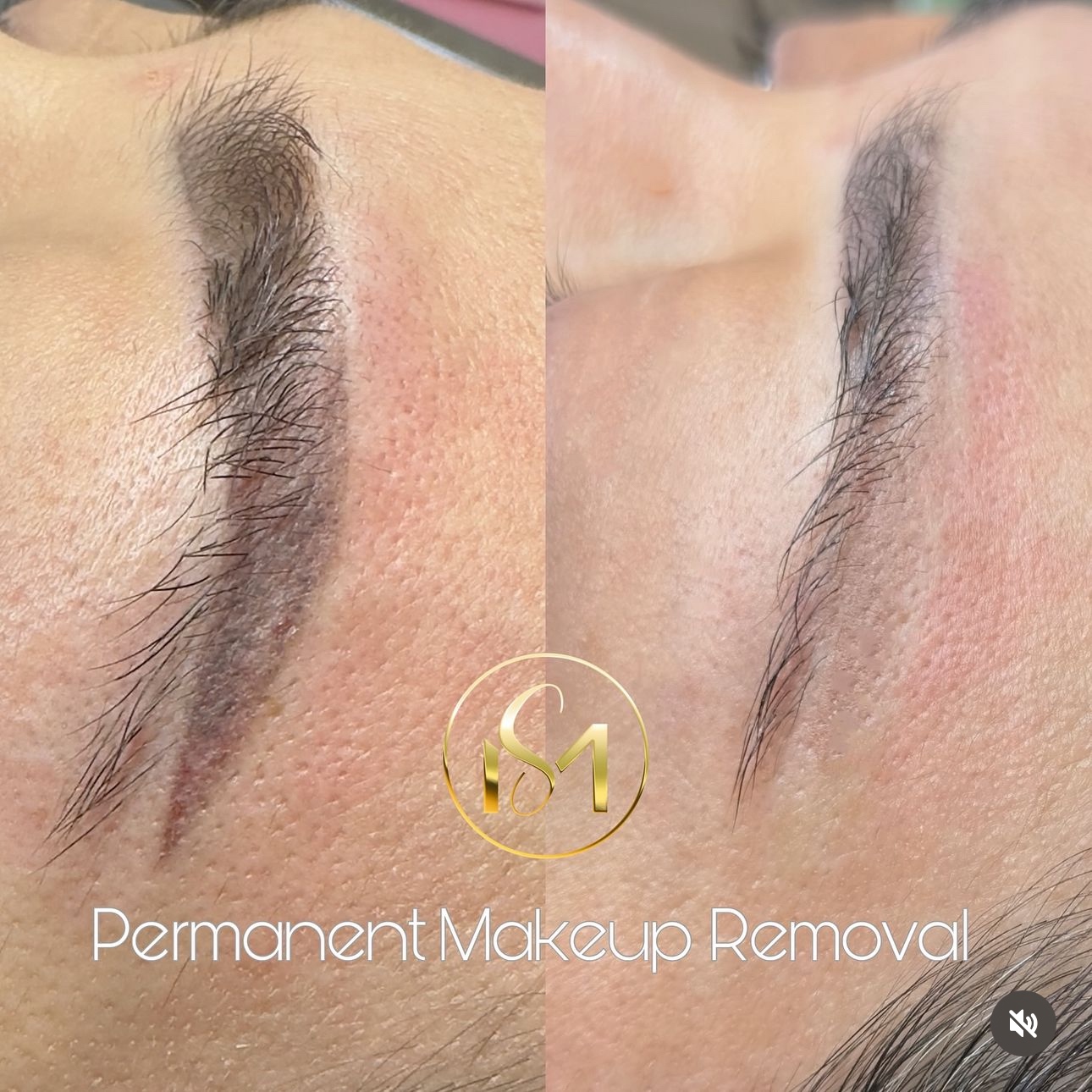 PIGMENT REMOVAL at Mahelia PMU Academy in Whittier., CA