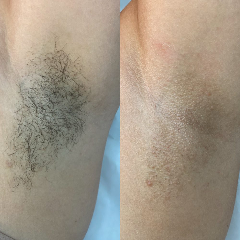 Underarms wax/ Depilacion Axilas