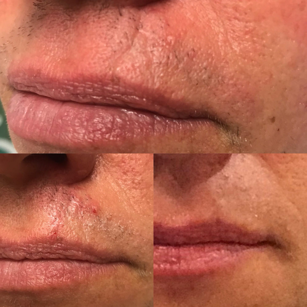Dryneedling Neck Lines/Scars at Rewind Med Spa in Longmont, CO