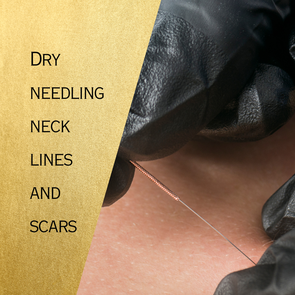 Dryneedling Neck Lines/Scars