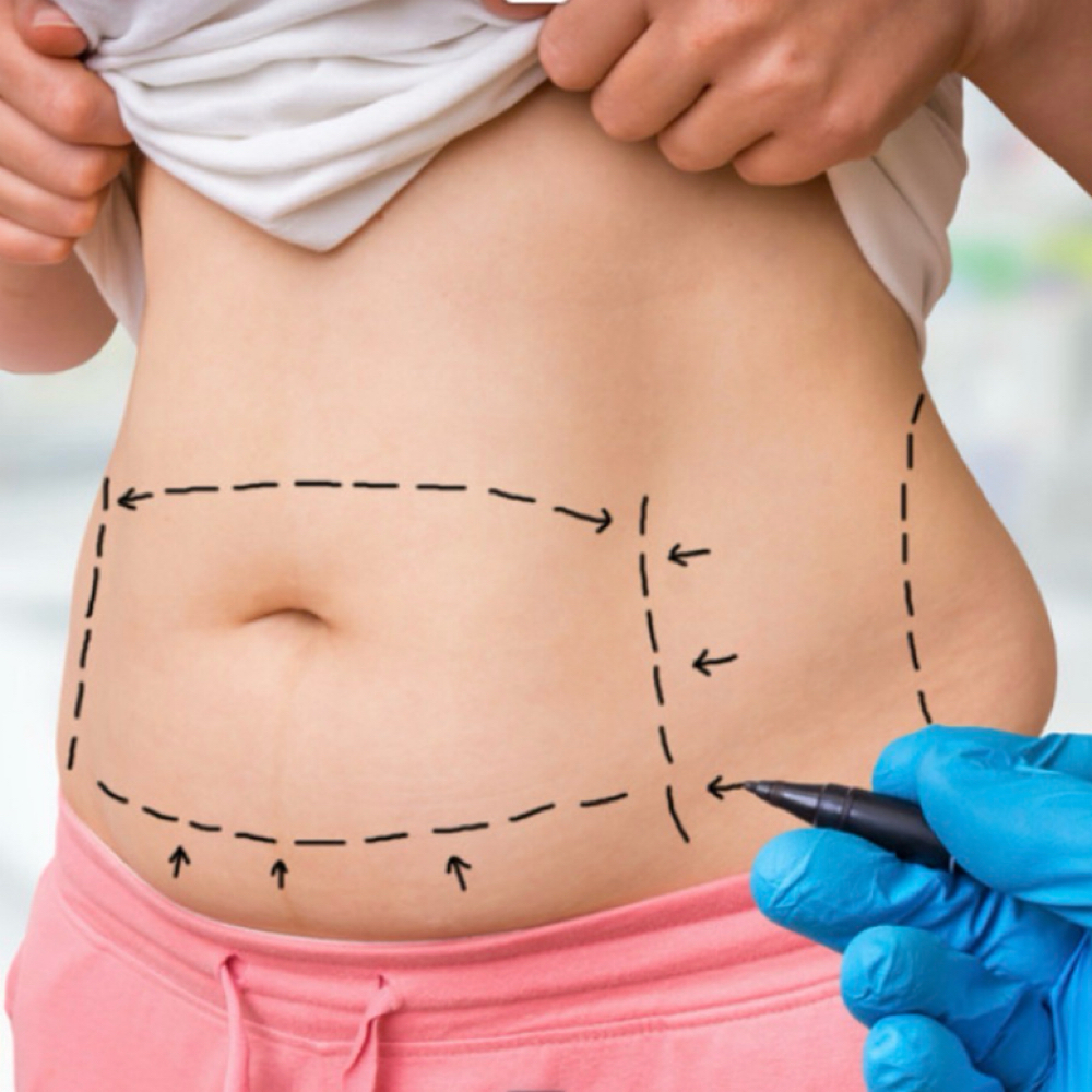 Lipo Dissolve at Merle Norman of Sharyland Spa and Boutique in Mission, TX