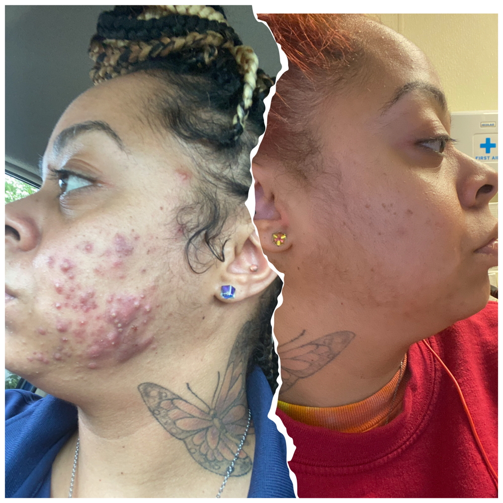 Acne Glow at Glow2Go in Cincinnati, OH
