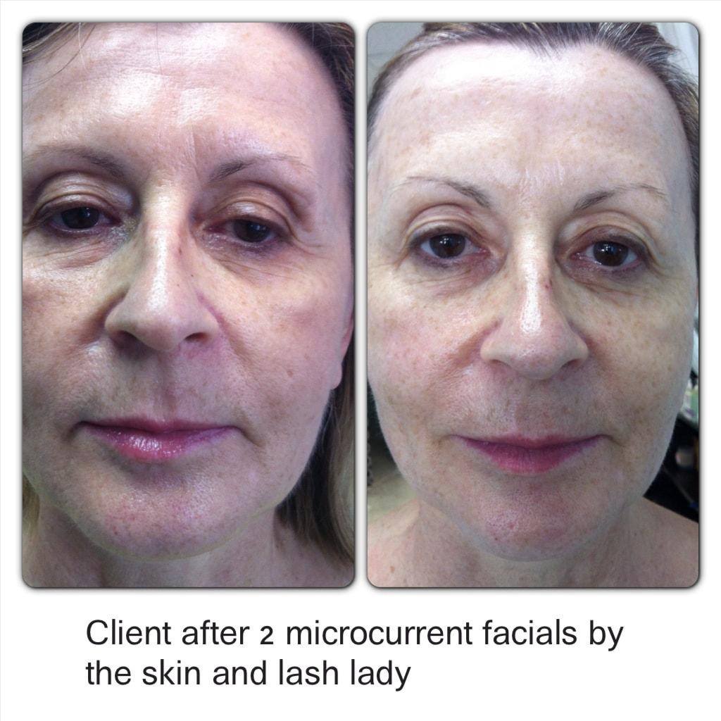 Microcurrent at BodyShots medSPA in Osseo, MN