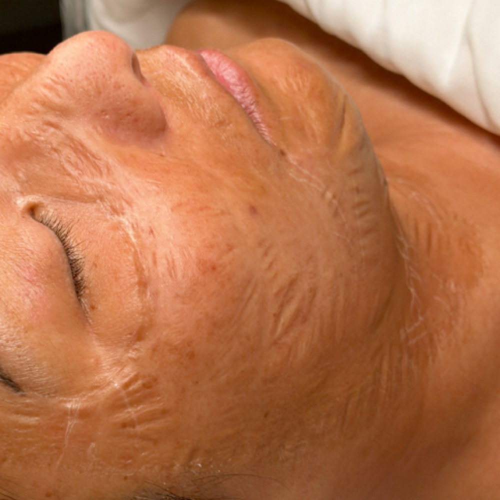 Tightening Treatment Add On at Bare + Balanced Aesthetics in Hudson, WI