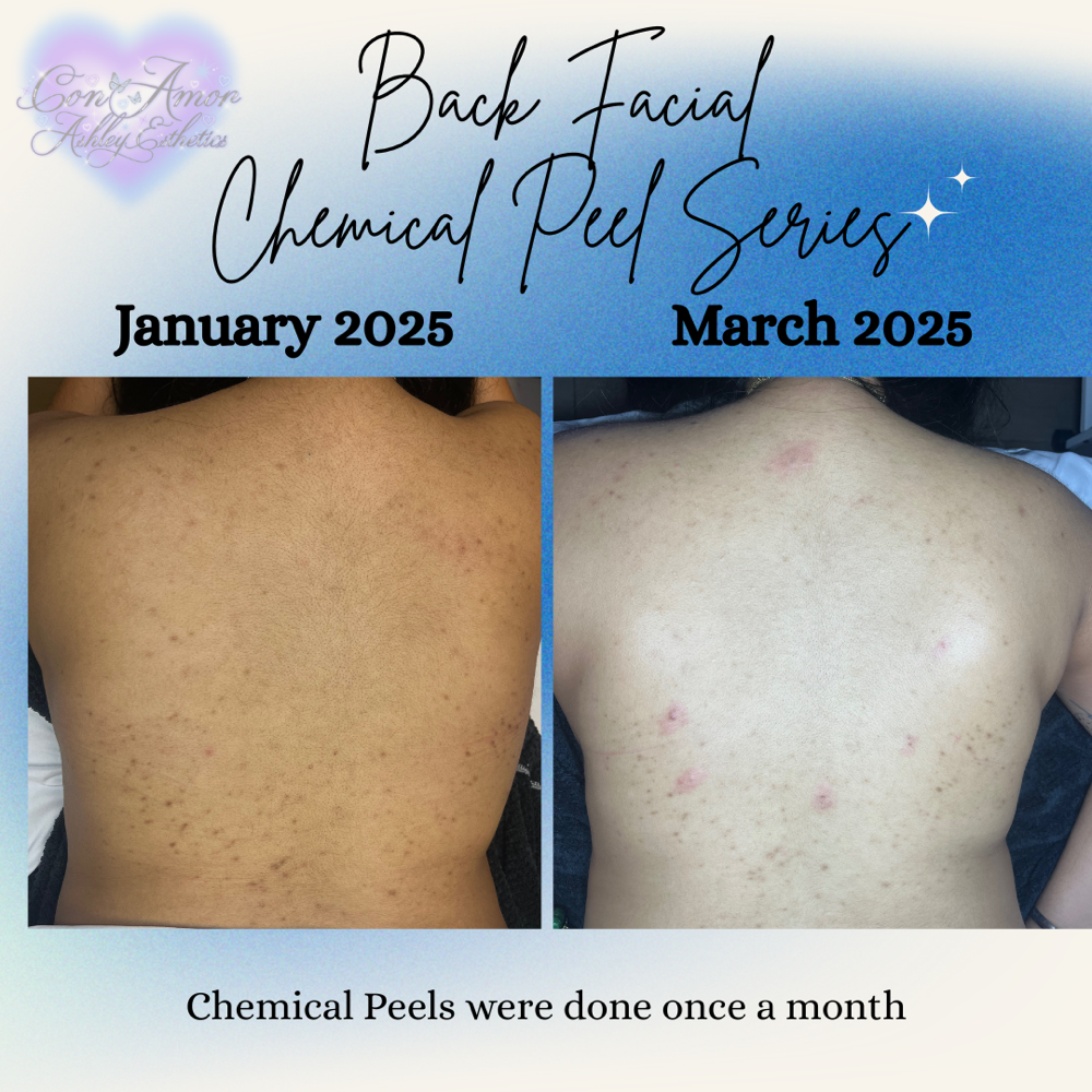 Back Facial Chemical Peel