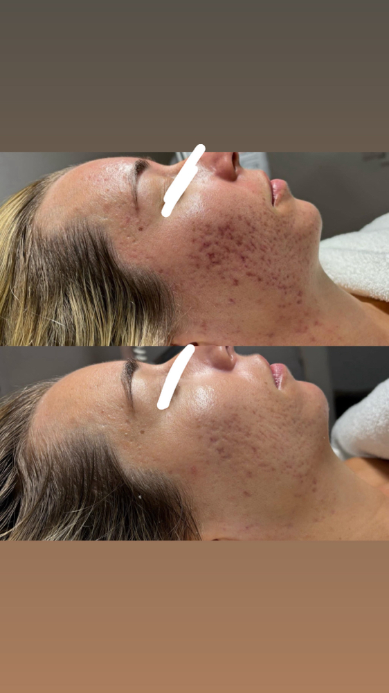 Bye Bye Breakouts - Acne Facial