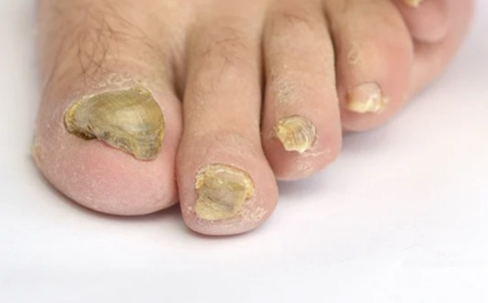 TREATMENT OF THICK NAILS (1 NAIL)