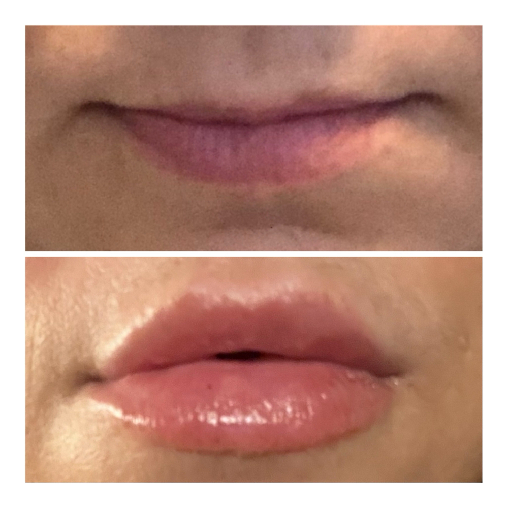 Lip Filler 1/2 Syringe