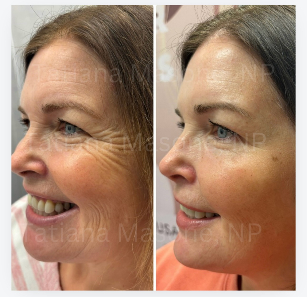 Cheek Filler