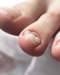 Treatment of Ingrown 2 little toe