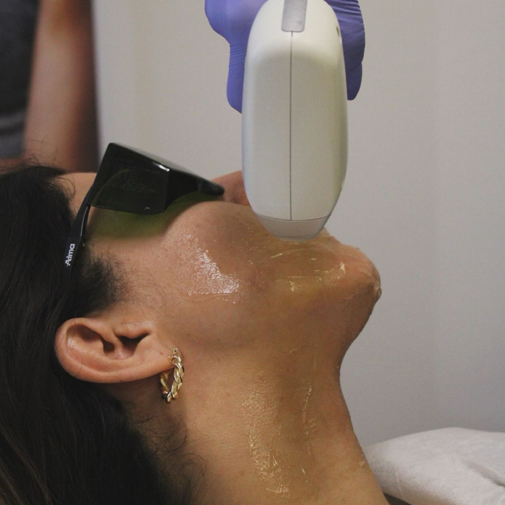 ULTIMATE LASER HAIR REMOVAL at MySkin Aesthetics in Laredo, TX