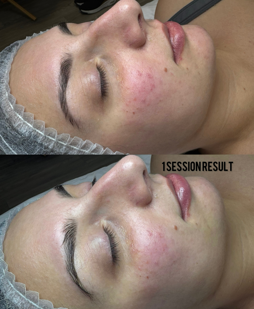 Rosacea Special Care at Healthy skin by Alvina in Highland Park, IL