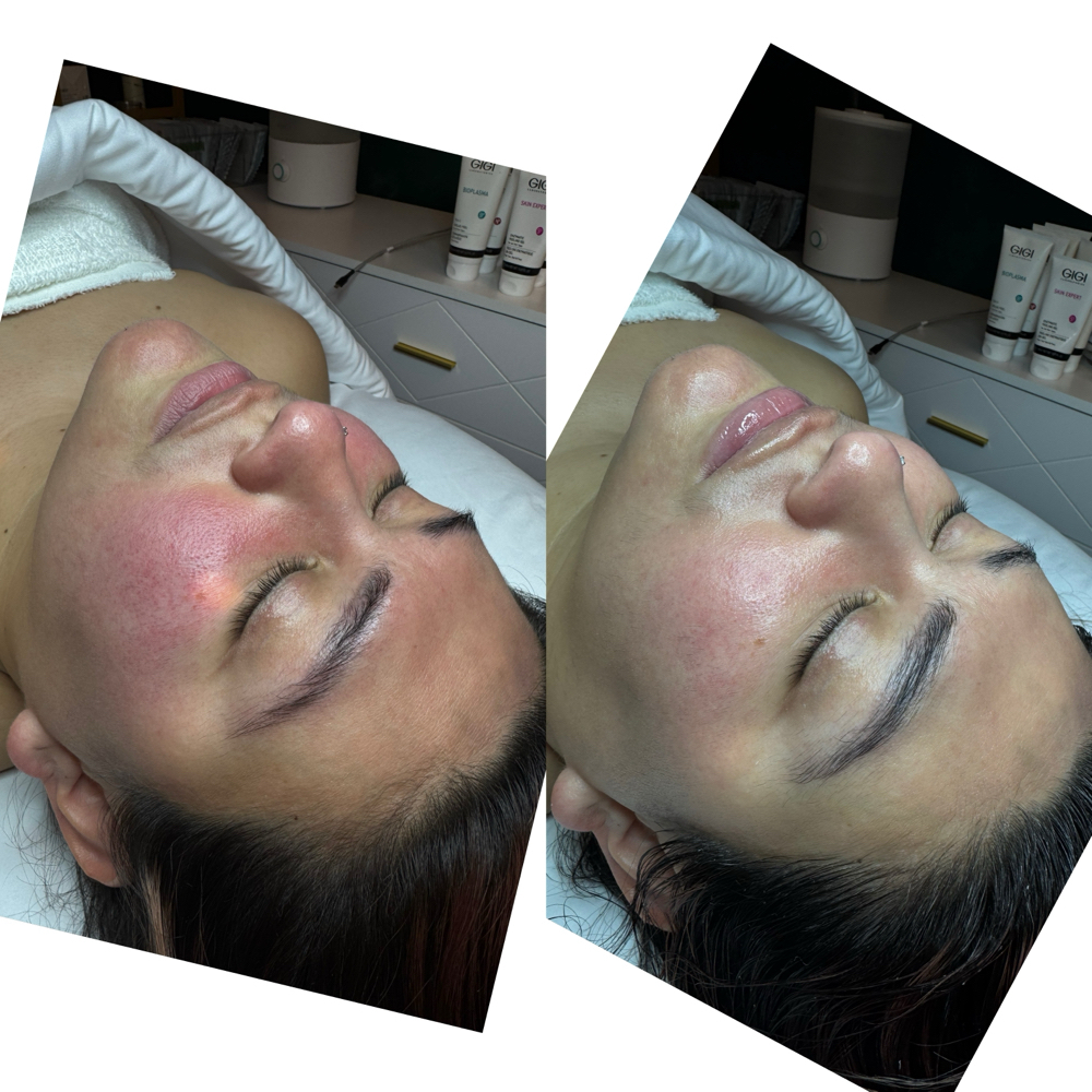 Rosacea Relief Facial at Healthy skin by Alvina in Highland Park, IL