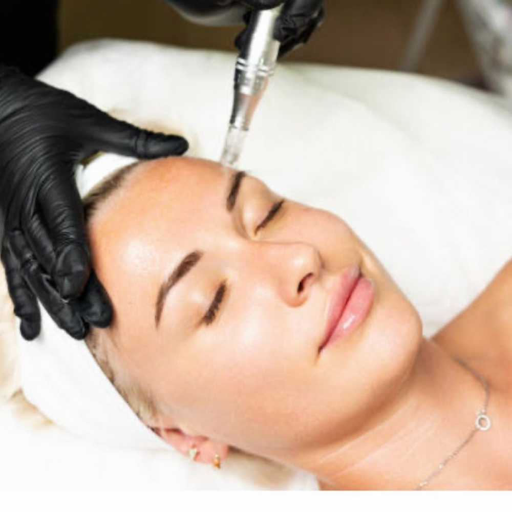 Microneedling w/Salmon PDRN at Snatched Waxing & Aesthetics in Denver, CO
