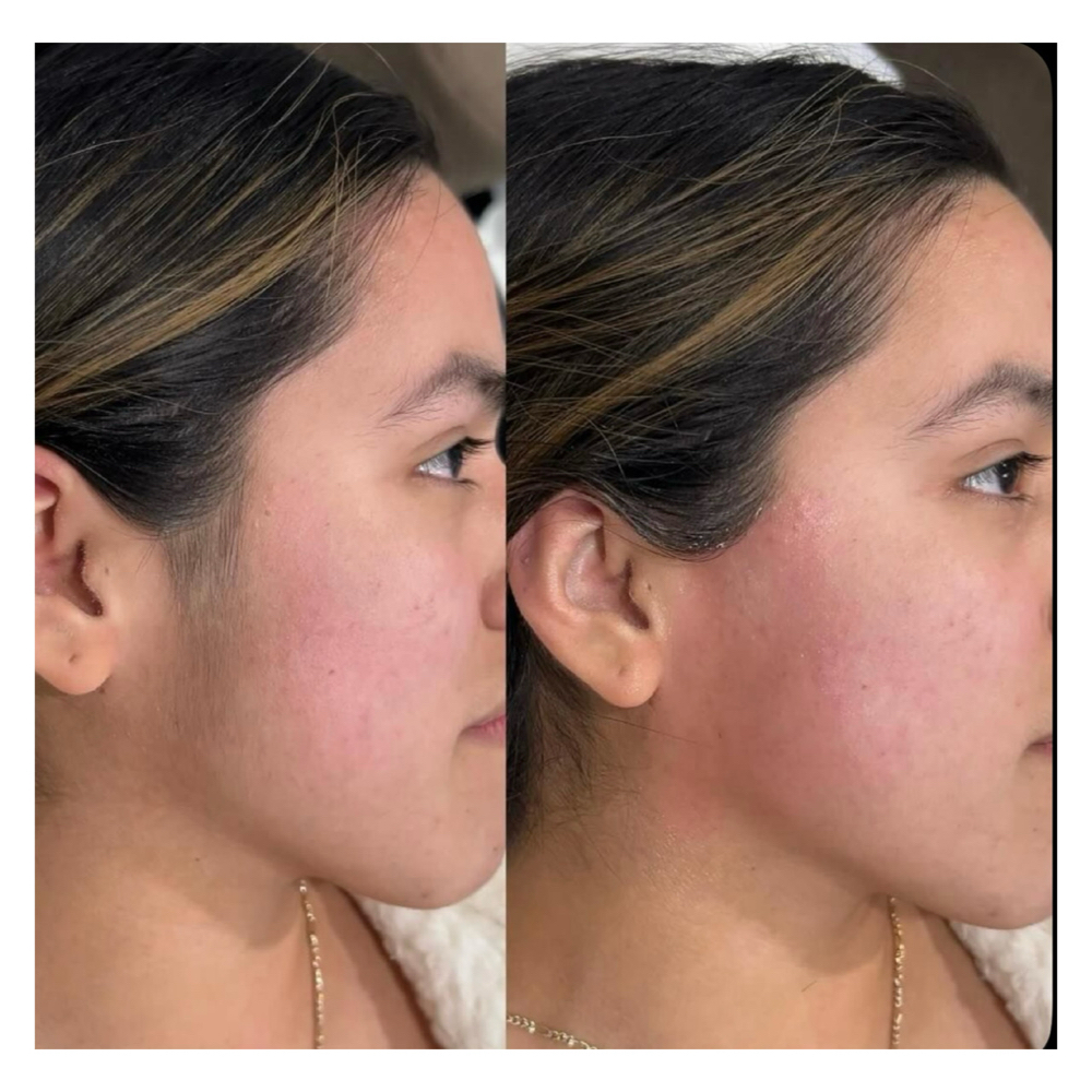 Sideburns at PureBeauty-Aesthetics in Colorado Springs, CO