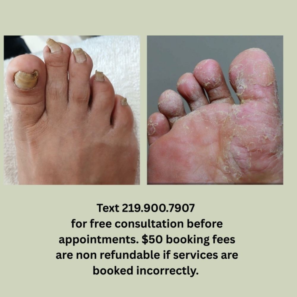 Antifungal Toenail & Callus Heels at Chicago's Favorite Nail Spa in Lansing, IL