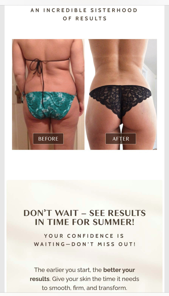 Cellulite Session at Essotara Wellness in Wausau, WI