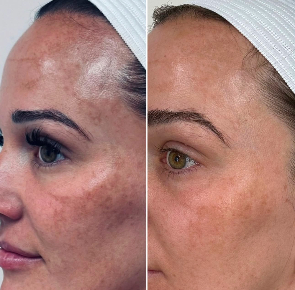 Custom Chemical Peel Series Of 3
