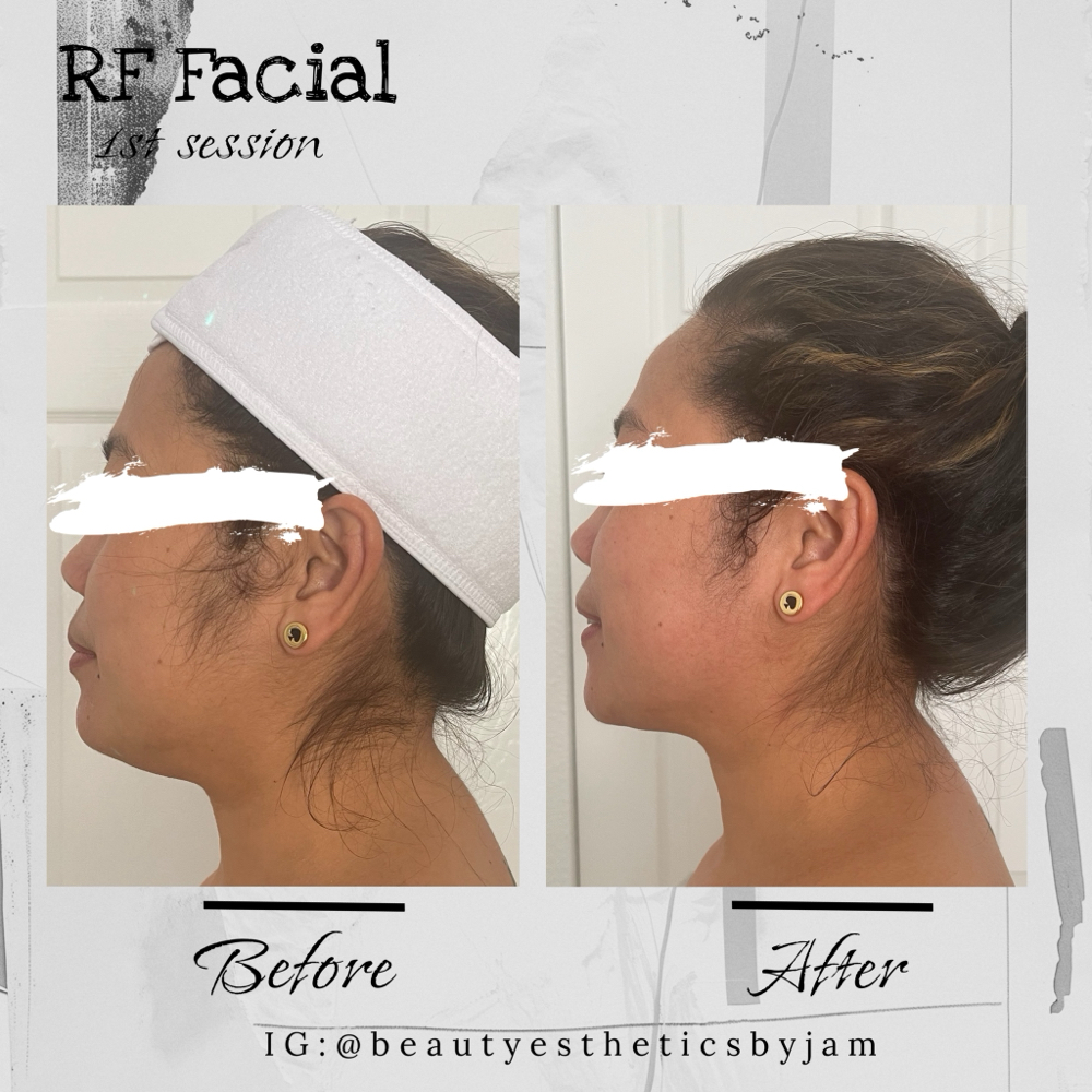 Buy 3 Get 1 Facial Toning