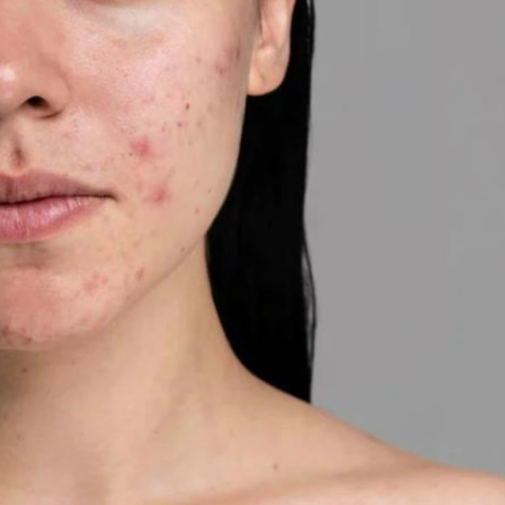 Spot Stop Facial