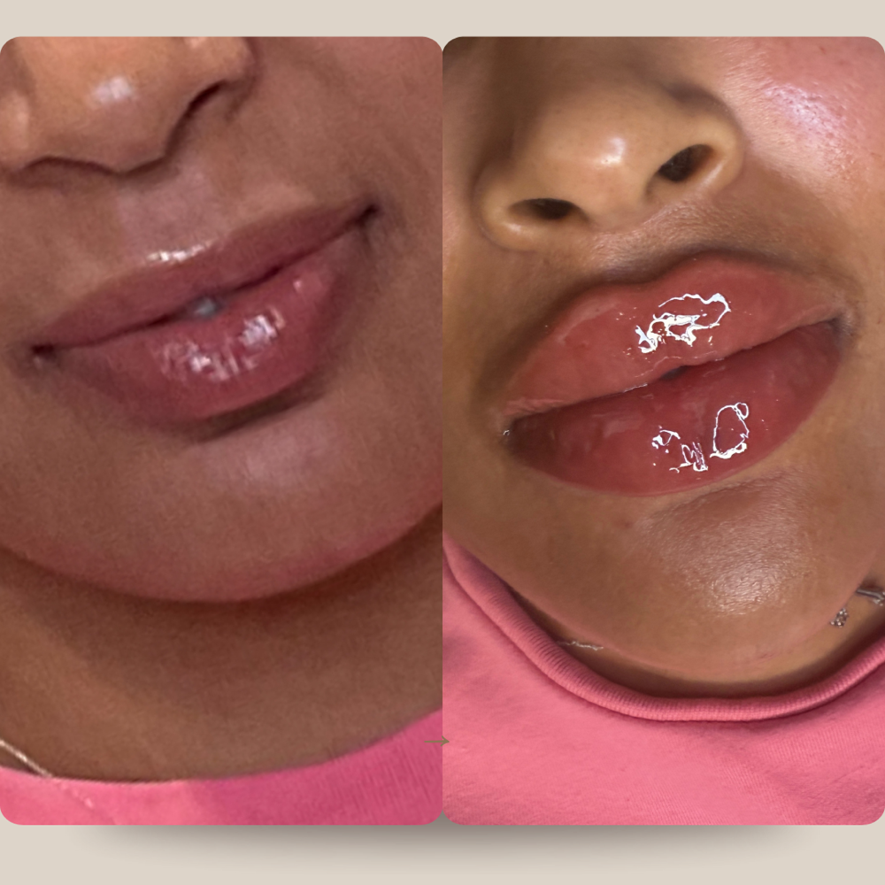 Lip filler -Full Syringe