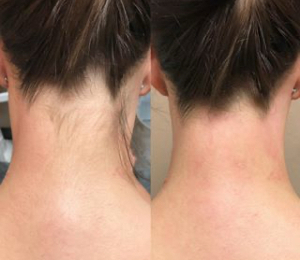 Nape of Neck