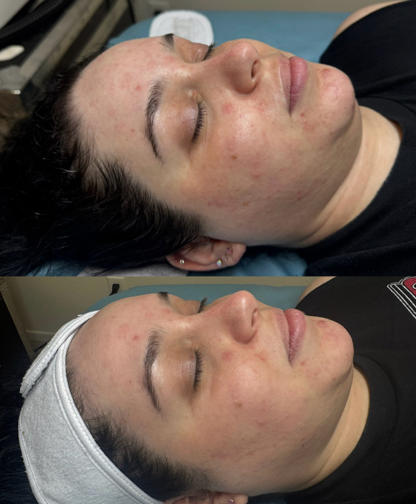 Hollywood Laser Peel 1st Sesh PROMO