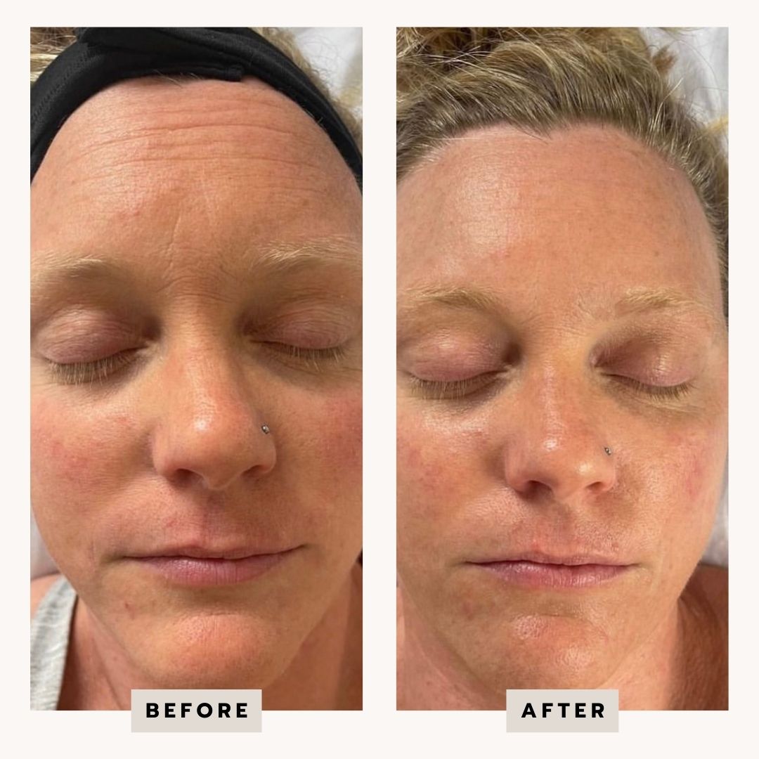 CARBOXY ANTI-AGING FACIAL