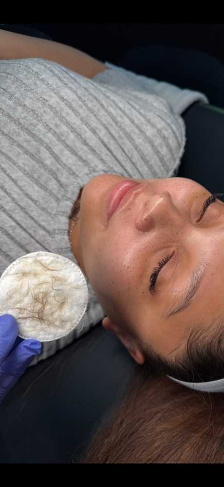 Dermaplane Treatment