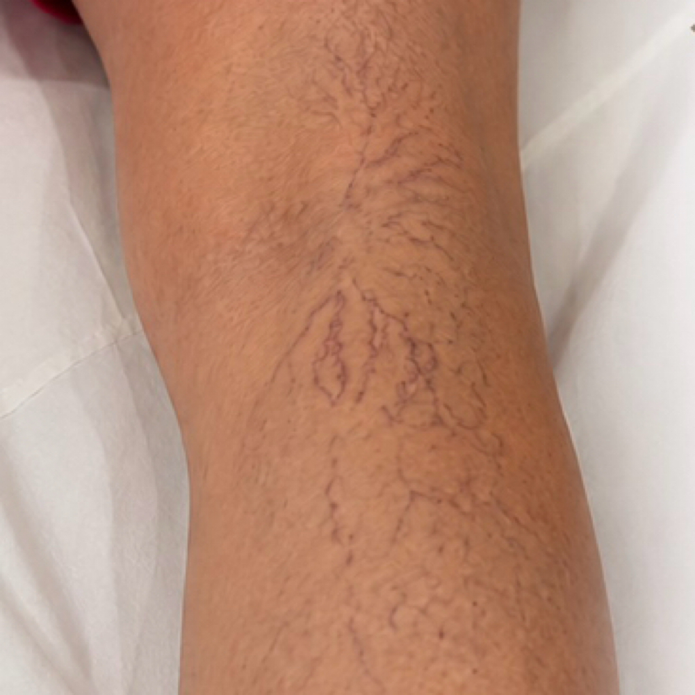 Sclerotherapy at Revive Aesthetics and Wellness in Ingleside, TX