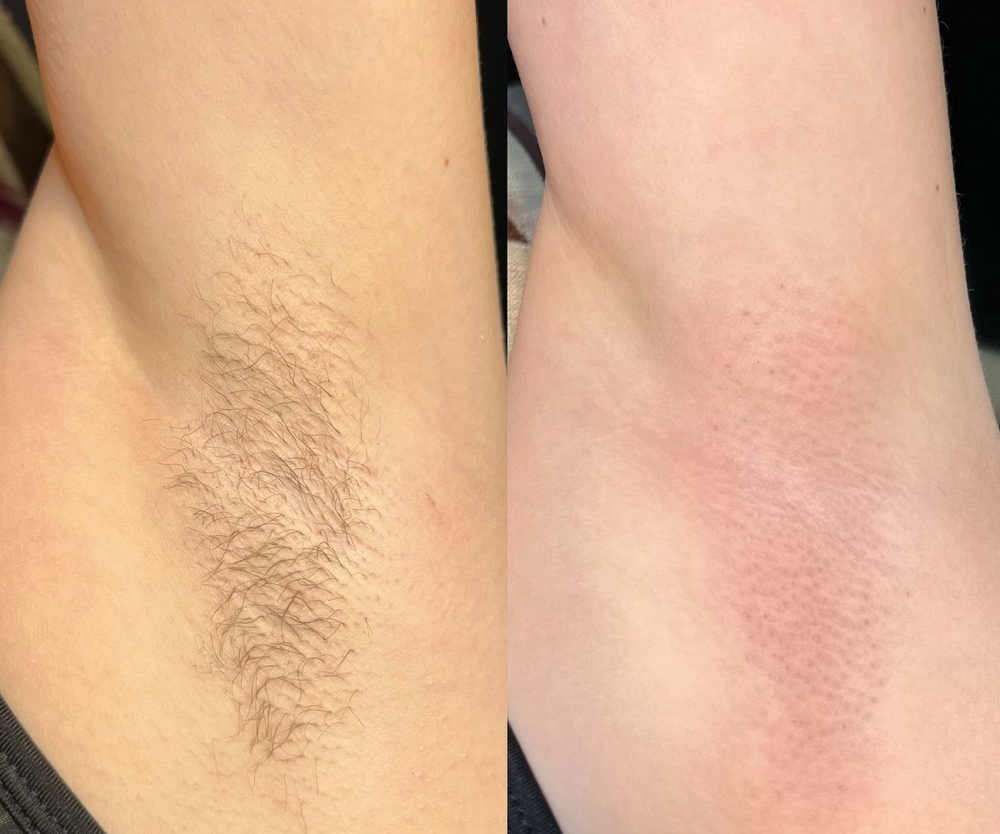 Underarm Waxing