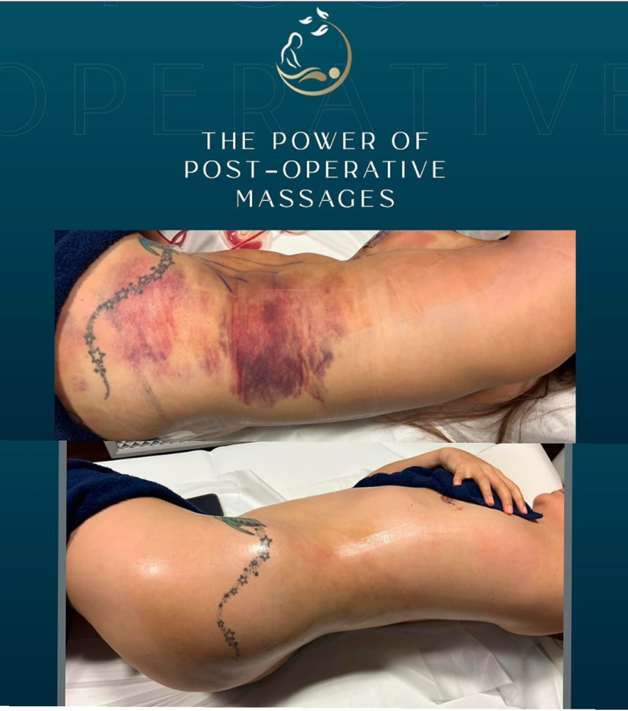 Lymphatic Massage-POSTOP MULTI AREA