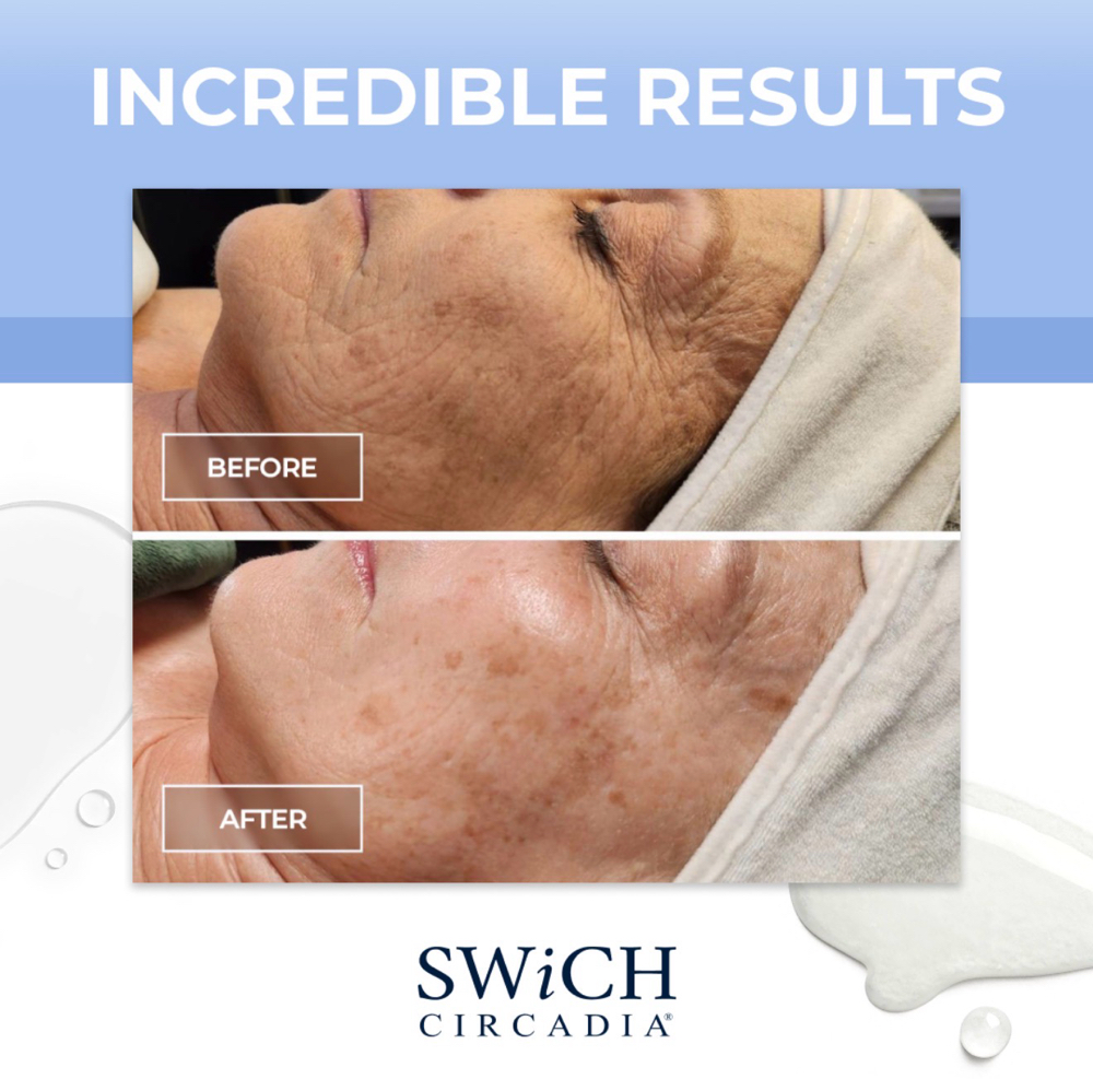 SWICH™ Dermal Rejuvenation System