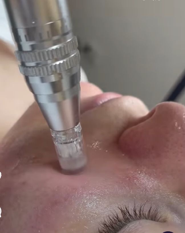 Micro Needling at ECLashes in Odessa, TX