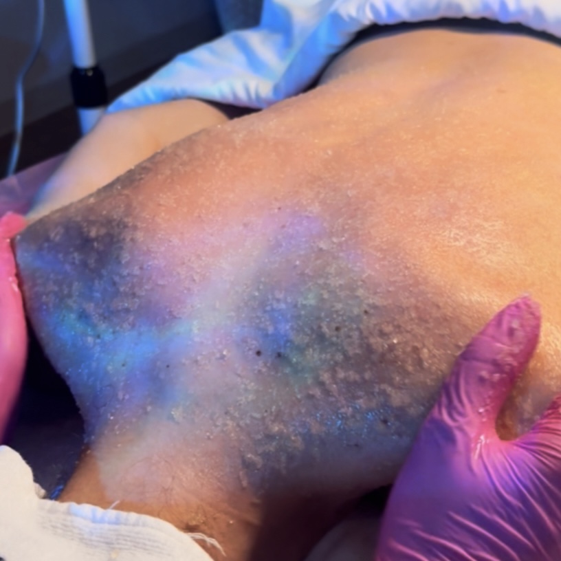 Back Clarifying Treatment
